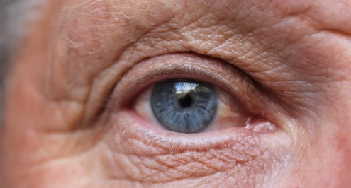 Age-Related Macular Degeneration