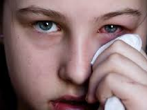 Allergic Conjunctivitis-4