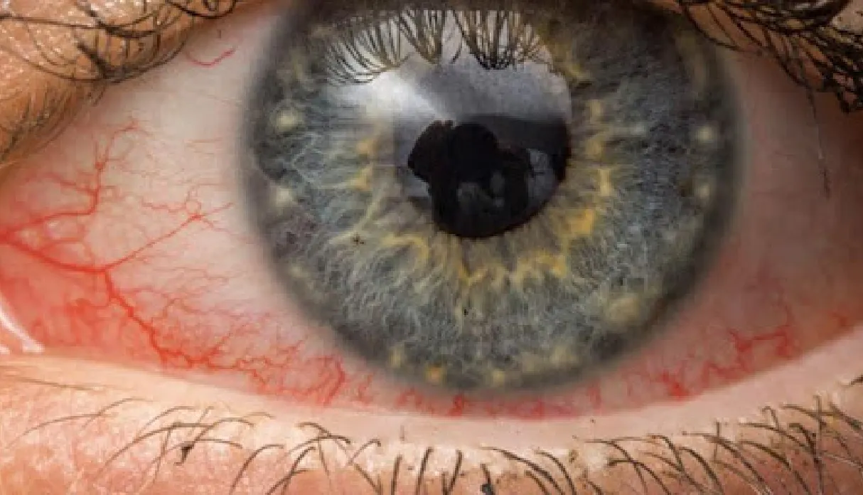 Allergic Conjunctivitis