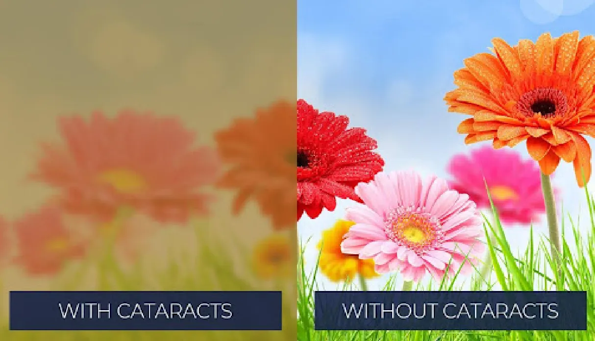 Cataract Surgery