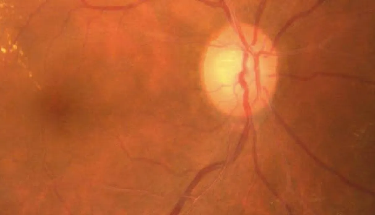 Central Serous Chorioretinopathy