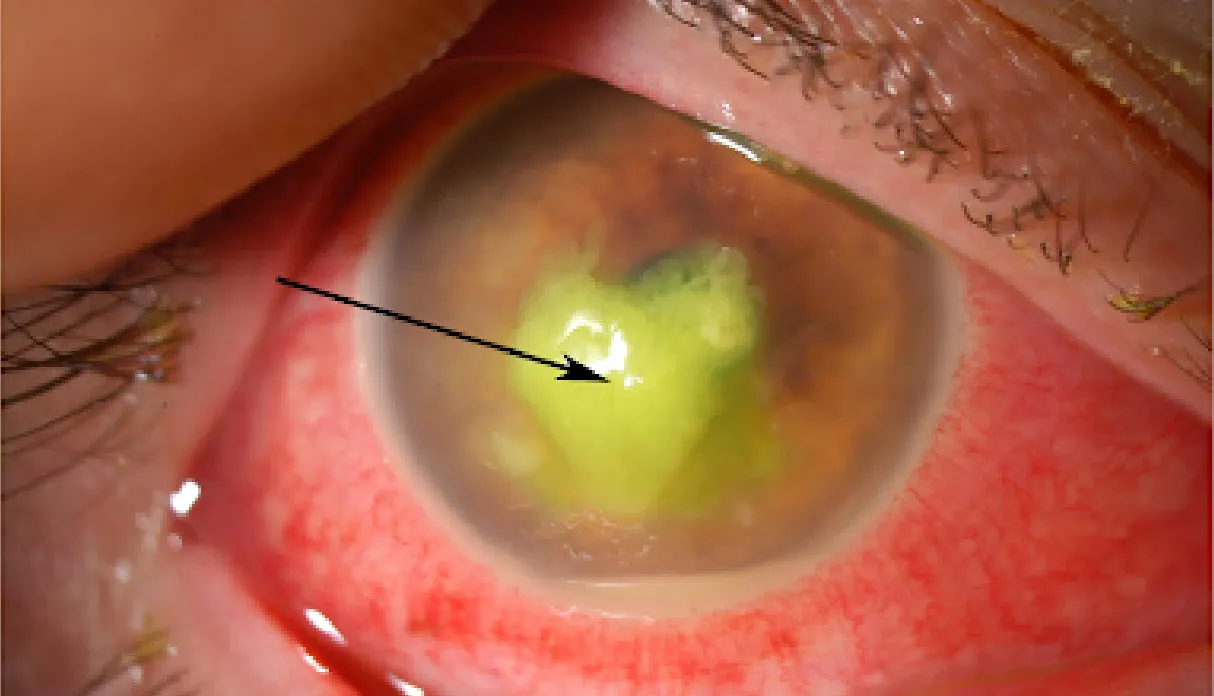 Corneal Ulcer