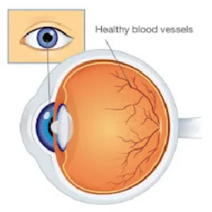 Diabetic Retinopathy