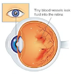 Diabetic Retinopathy