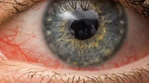  Allergic Conjunctivitis