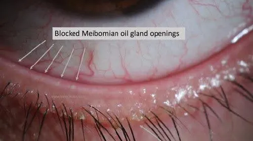 Meibomian Gland Dysfunction