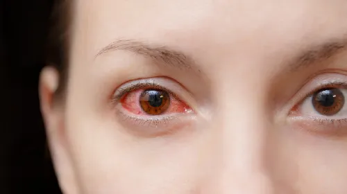 Pink Eye