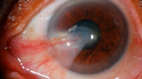 Pterygium