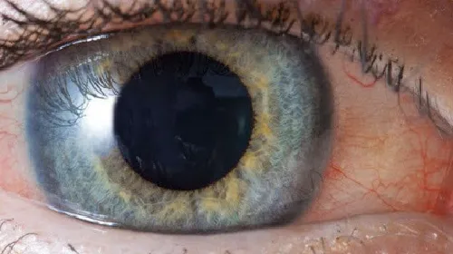 Uveitis