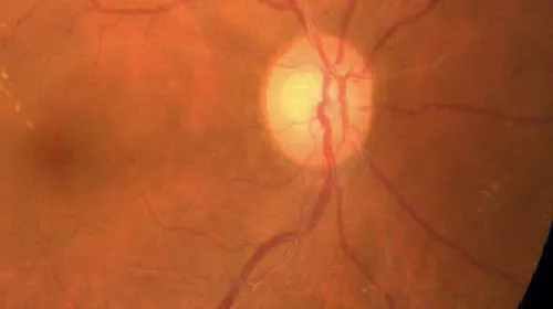 Central Serous Chorioretinopathy