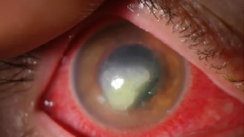Corneal Ulcer