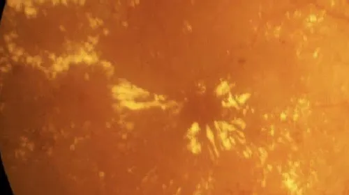 Dry age-related macular degeneratio