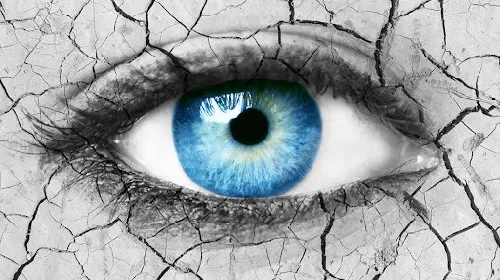 Dry Eye Syndrome or Tear Film Dysfunction