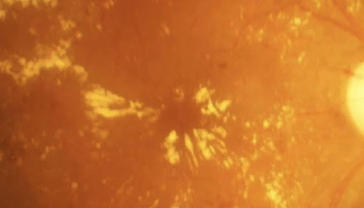 Dry Age-related Macular Degeneration