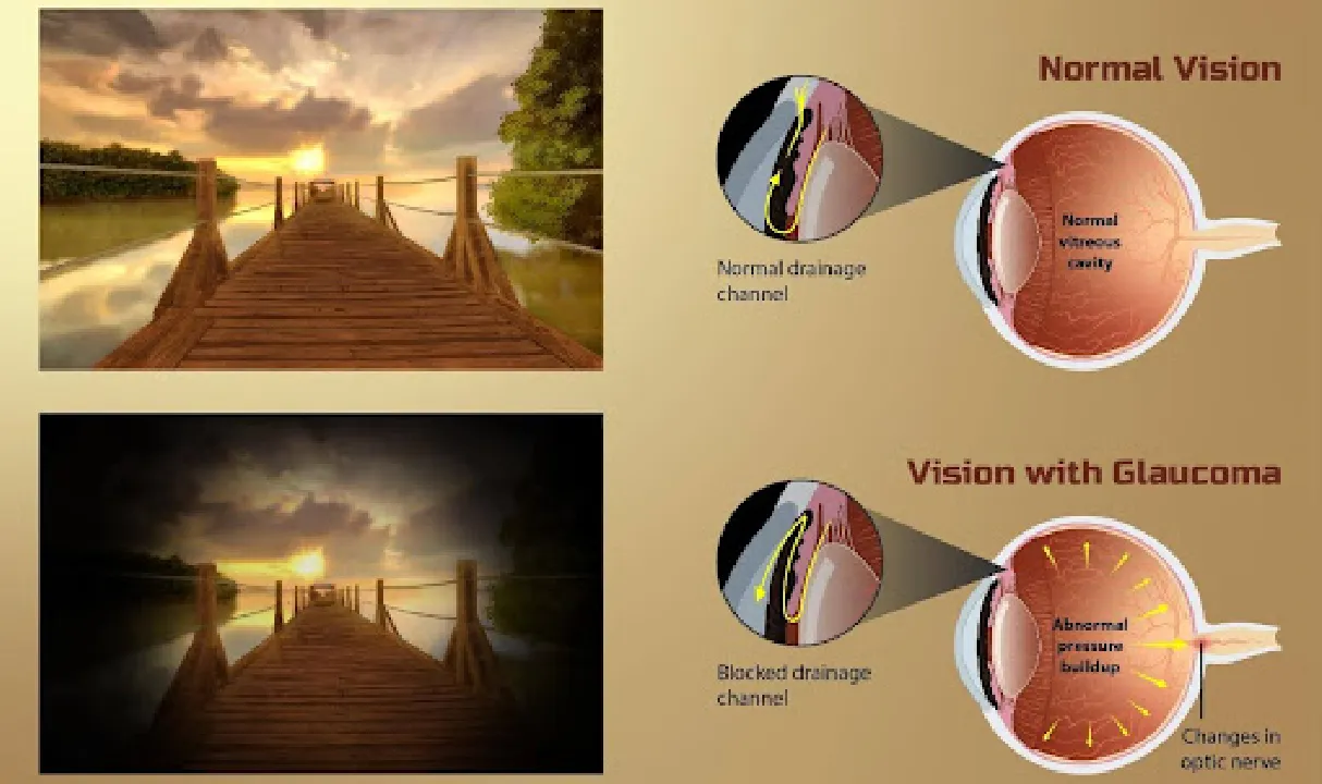 Glaucoma