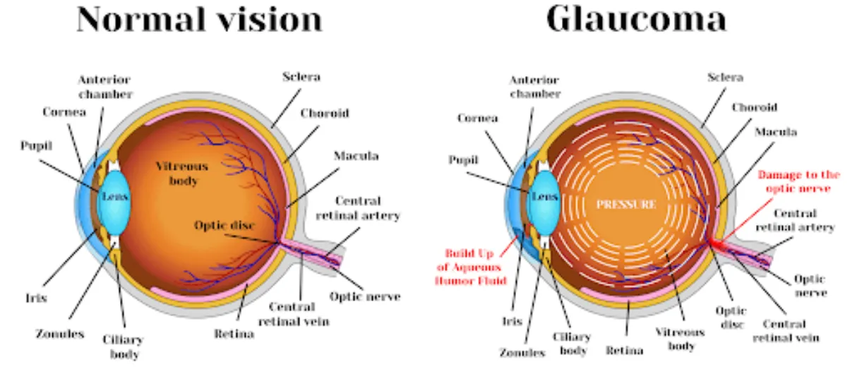 Glaucoma