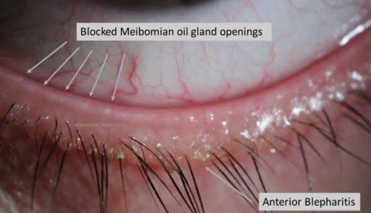 Meibomian Gland Dysfunction