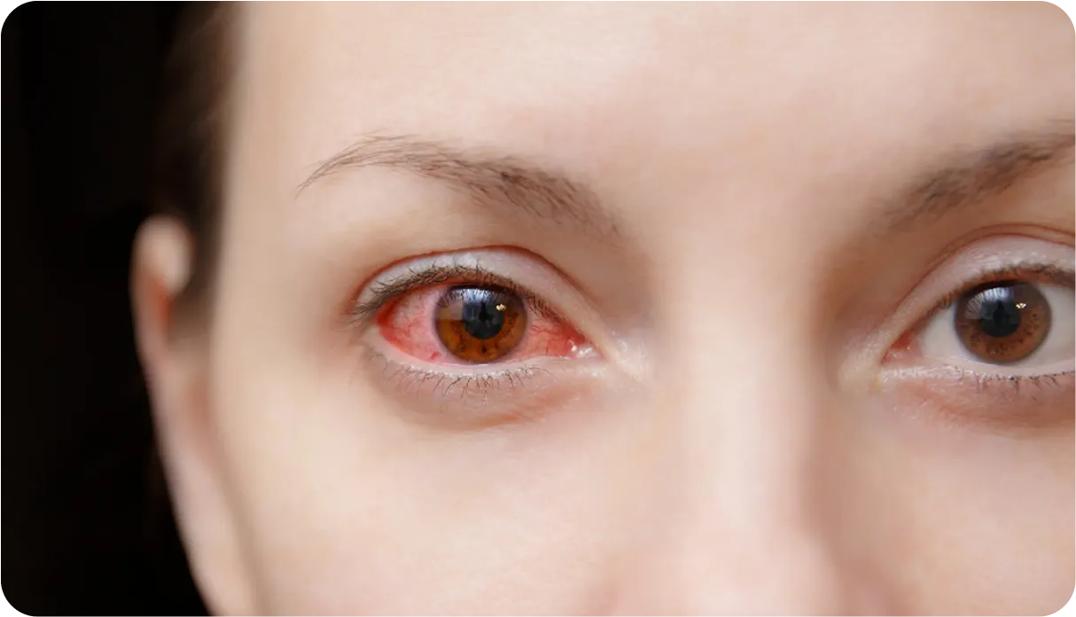 Pink Eye