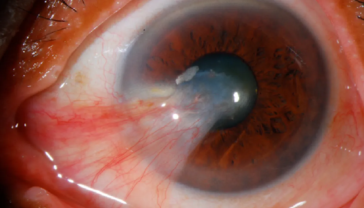 Pterygium