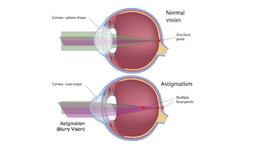 Refractive Surgery