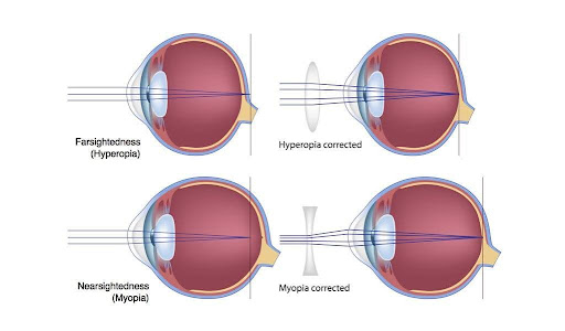Refractive Surgery
