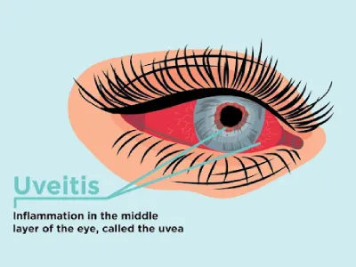 Uveitis