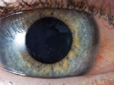 Uveitis